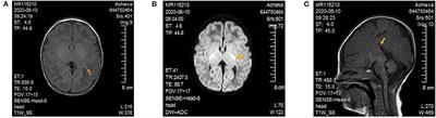 Novel GLDC Compound Heterozygous Variant Leading to Nonketotic Hyperglycinemia: Case Report and Literature Review